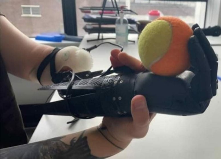 Wiki holding a tennis ball in her bionic arm. The bionic arm is wired up to her left partial arm, but is being held in her right hand to show how it works.